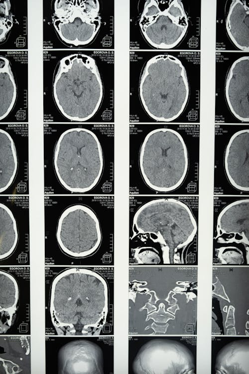 MRI scan of the brain showing detailed imaging used to diagnose traumatic brain injuries