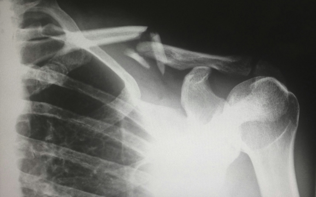 X-ray image showing a broken shoulder bone after an injury