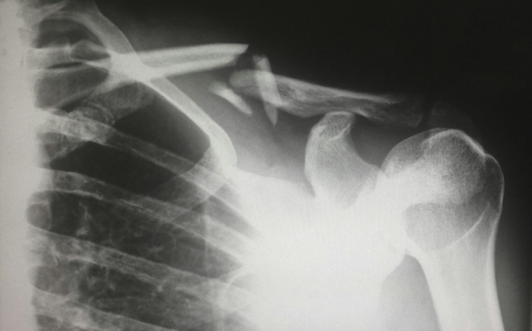 X-ray image showing a broken shoulder bone after an injury